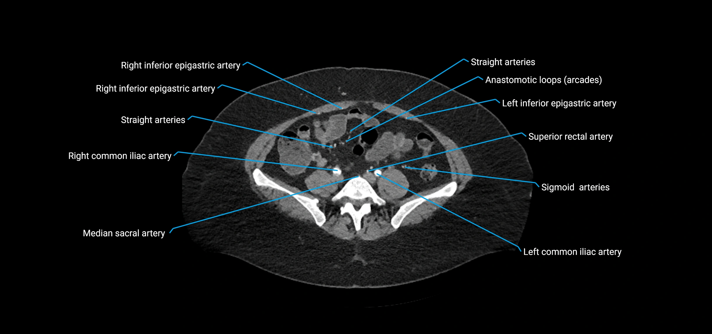 CTA abdomen axial cross sectional anatomy labelled image_166 (2).webp